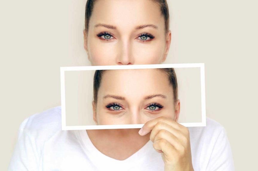 Transformations: Lower Blepharoplasty Before and After